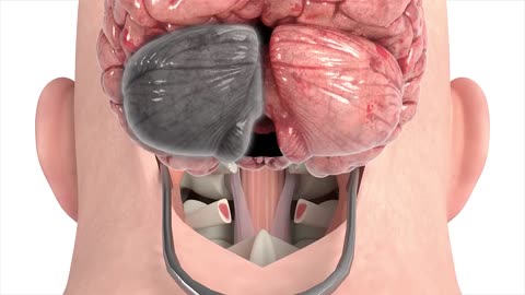 Craniectomy brain surgery 3D animation