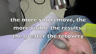 How To Look Younger With Laser Resurfacing