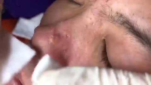 Cleaning Giant Blackheads and Pimples 2