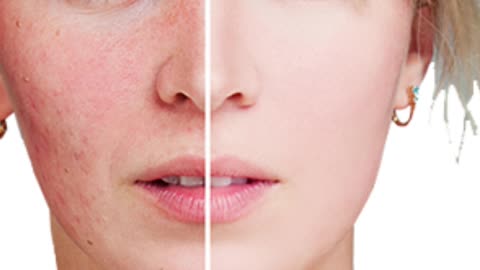 ROSACEA: PRODUCT TO RELIEVE