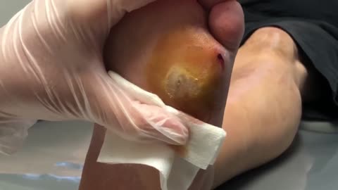 EXPLODING Abscess From Sharp Nail!!