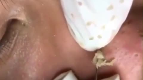 dr pimple popper remove