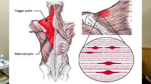 For trigger points, knots, and stubborn muscles