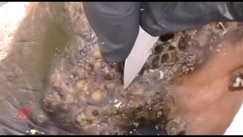 Removing Parasitic Jiggers from severely infested foot!