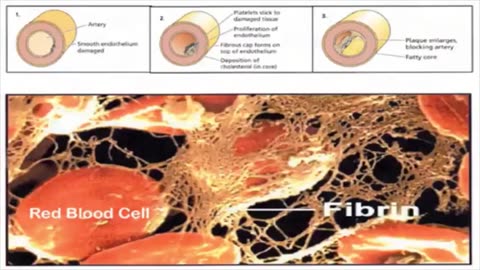 SERRAPEPTASE & NATTOKINASE- BLOODCLOTS, FIBRINS, CLOGGED ARTERIES, JOINTS... MUCH MORE