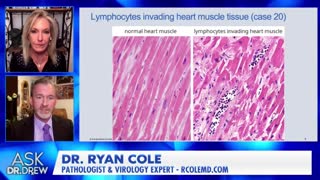 “Foot-Long Blood Clots” from mRNA Shots: Dr. Drew Interviews Pathologist Dr. Ryan Cole