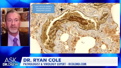 “Foot-Long Blood Clots” From mRNA, Says Pathologist Dr. Ryan Cole w/ Dr Kelly Victory