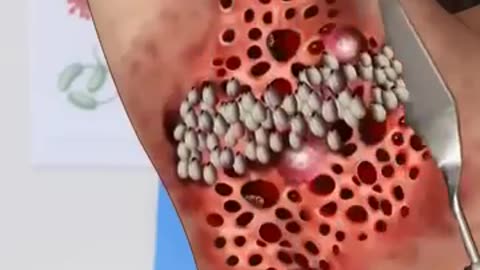 ज़ख्मी घाव का |3D ANIMATION TREATMENT #shots #viral #trending #asmr #yotubeshorts@MrBeast