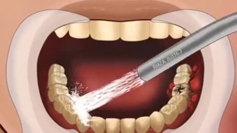 Teeth treatment 3d animation full