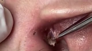 Blackheads removal