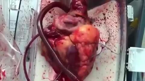 Footage of a beating heart just before a transplant