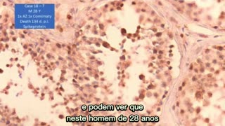 ⚠️😱💉Dr. Arne Burkhardt - A proteína Spike está nos testículos, quase que não tem espermatócitos😱💉⚠️