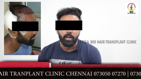 9 Months Hair Transplant Result