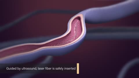 Endovenous Laser Ablation - Medical Animation
