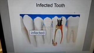 Prevent a Root Canal