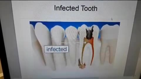 Prevent a Root Canal