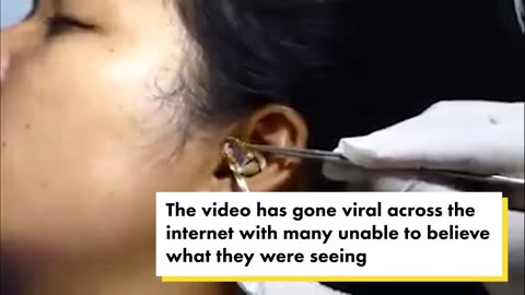 'Surgeon' struggles to remove live snake from woman's ear in viral video