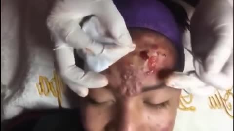 LARGE Head Blackheads Acne Removal Girl 18 Years Old Pimple Popping 2021