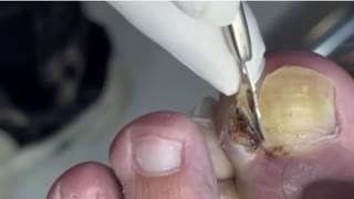OH MY GOD!! Painful Toenail Ingrown Removal!!!