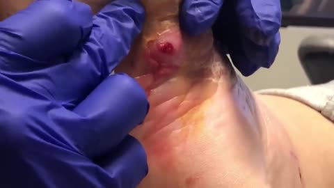 INSANE INCLUSION CYST