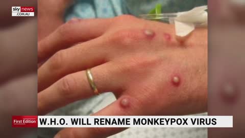 World Health Organisation to rename Monkeypox