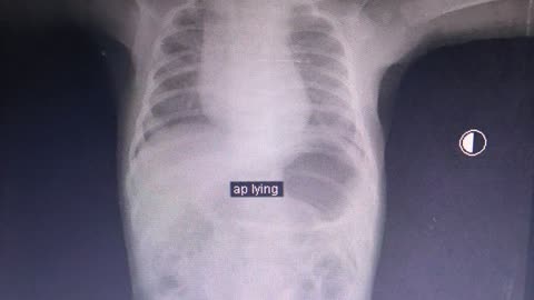 X Ray chest