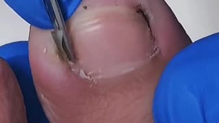 Foot toenail trimming process