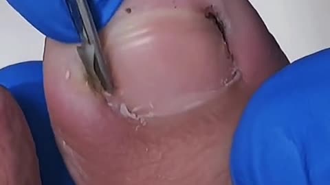 Foot toenail trimming process