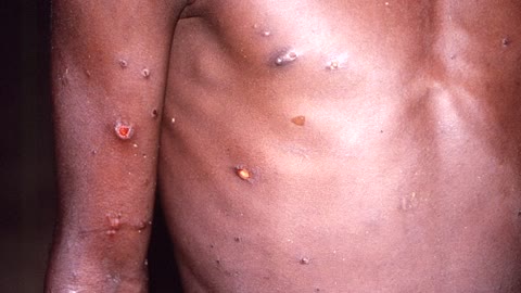 Why are monkeypox cases rising?