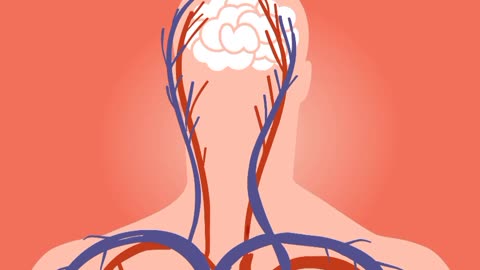 how stroke happens how someone get stroke mechanism of stroke