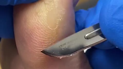 Big toe callus removal by Australian podiatrist