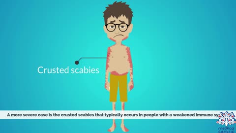 Unveiling SCABIES Causes, Signs, Symptoms, Diagnosis, and Effective Treatment Methods