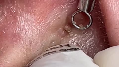 Satisfying with Popping Blackheads in Ear