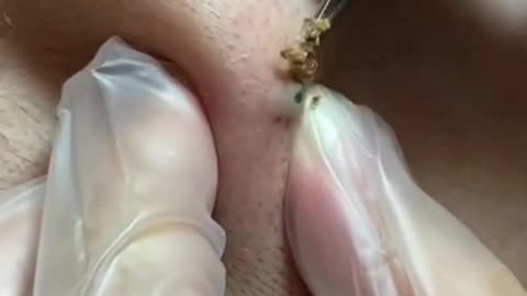 Blackhead removal video