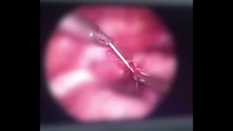 Docs Find 2-Inch Splinter In No-Walk 7yo Girls Hip