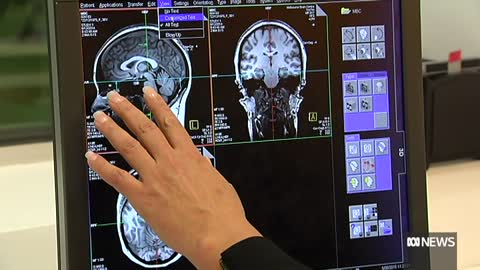 Drug slows cognitive decline in patients with early stages of Alzheimer's disease _ The World