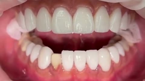 The revolutionary way to white teeth in a natural way