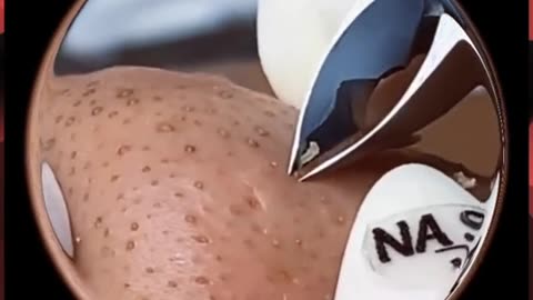 Big plPimple Blackheads Remove