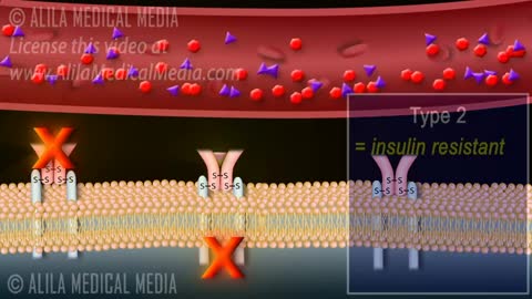 Diabetes Type 1 and 2, Animation.