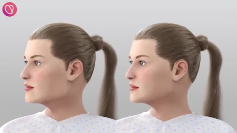 Natančnost v operaciji feminizacije čeljusti in brade by matej rotovnik