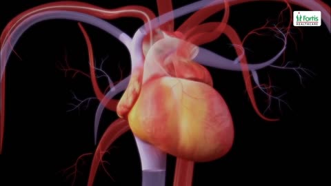 Heart attack | angioplasty Animation |2023|AIM Pharma