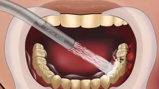 SATISFYING ASMR ( TREATMENT OF SEVERE TOOTH DECAY) @Satisfying_ ASMR _Animations