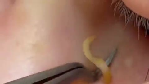 CYST PIMPLE POPPING EXTREME POPPING BLAC