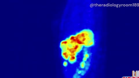 How Does a PET Scan Work.