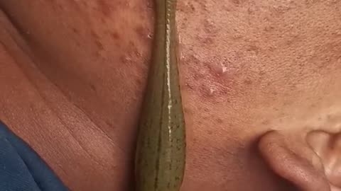 Leech Therapy For Skin Problems