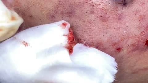 Crazy cyst extraction