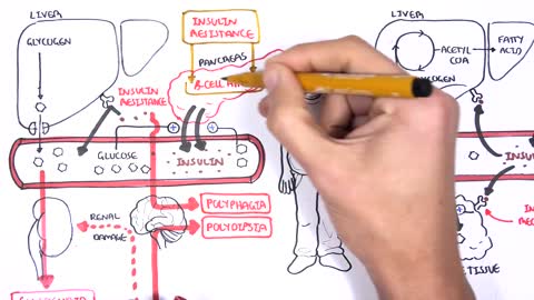 Diabetes Type II Pathophysiology