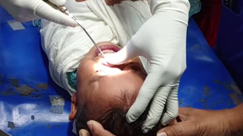 Removing forign body from nose