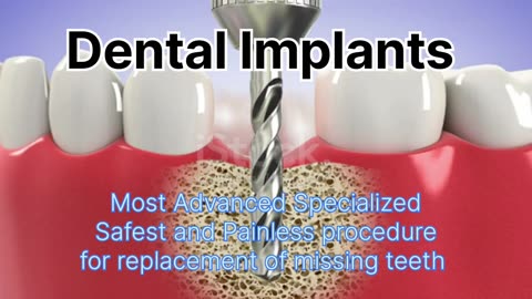 Dental implants