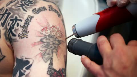 Can You Get A Cover-up Tattoo After Laser Tattoo Removal?